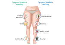 Clinical Trial Shows Pycnogenol® May Relieve Lipedema Symptoms and Improve Quality of Life in Women